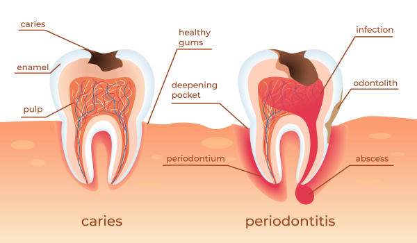 nhiễm trùng tủy răng