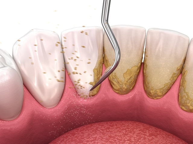 Cạo vôi răng có hại không và 5 quan niệm sai lầm về việc lấy vôi răng -