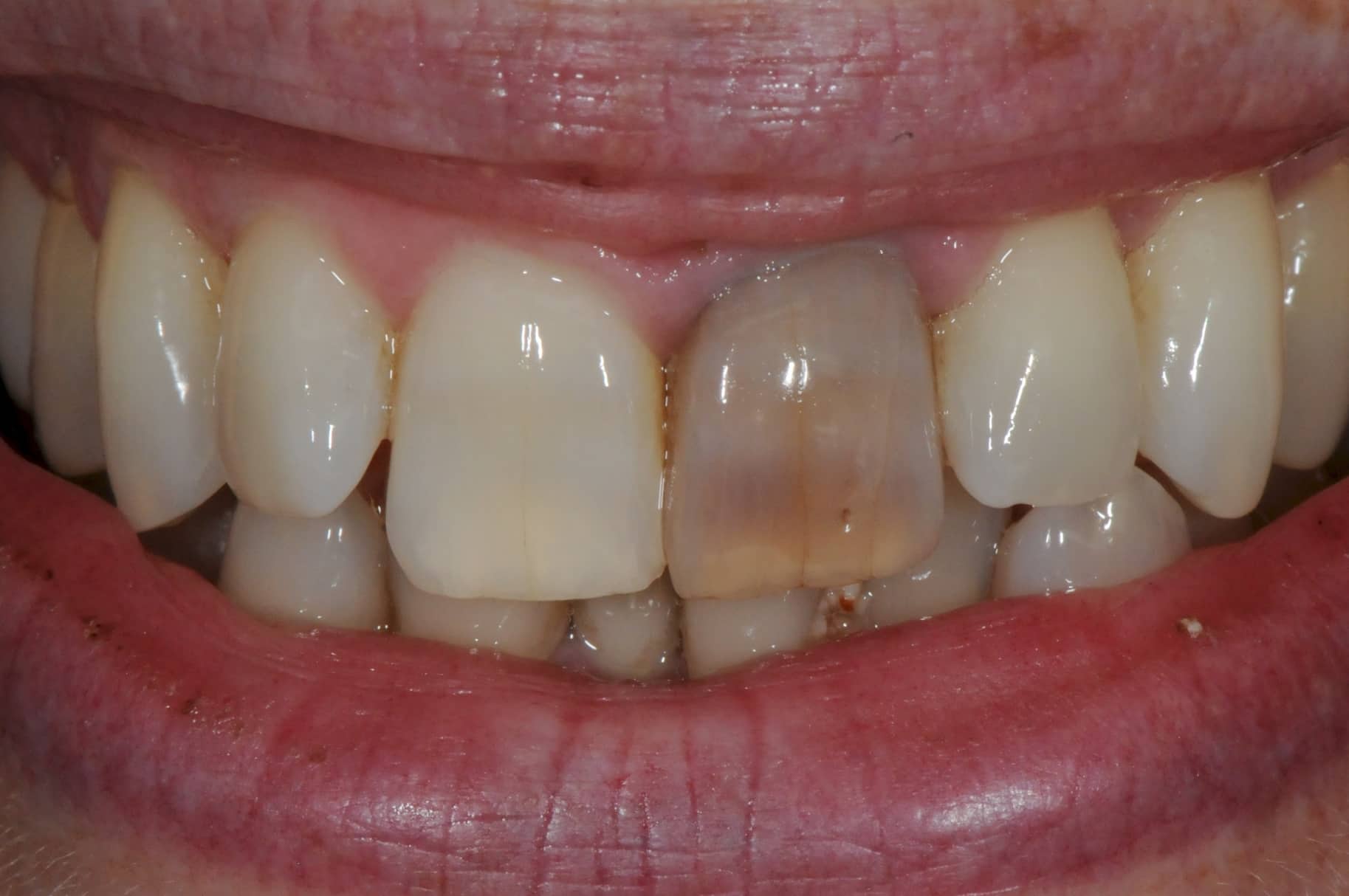 đổi màu răng do viêm tủy