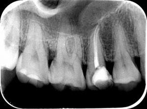 phim x quang răng đã điều trị tuỷ