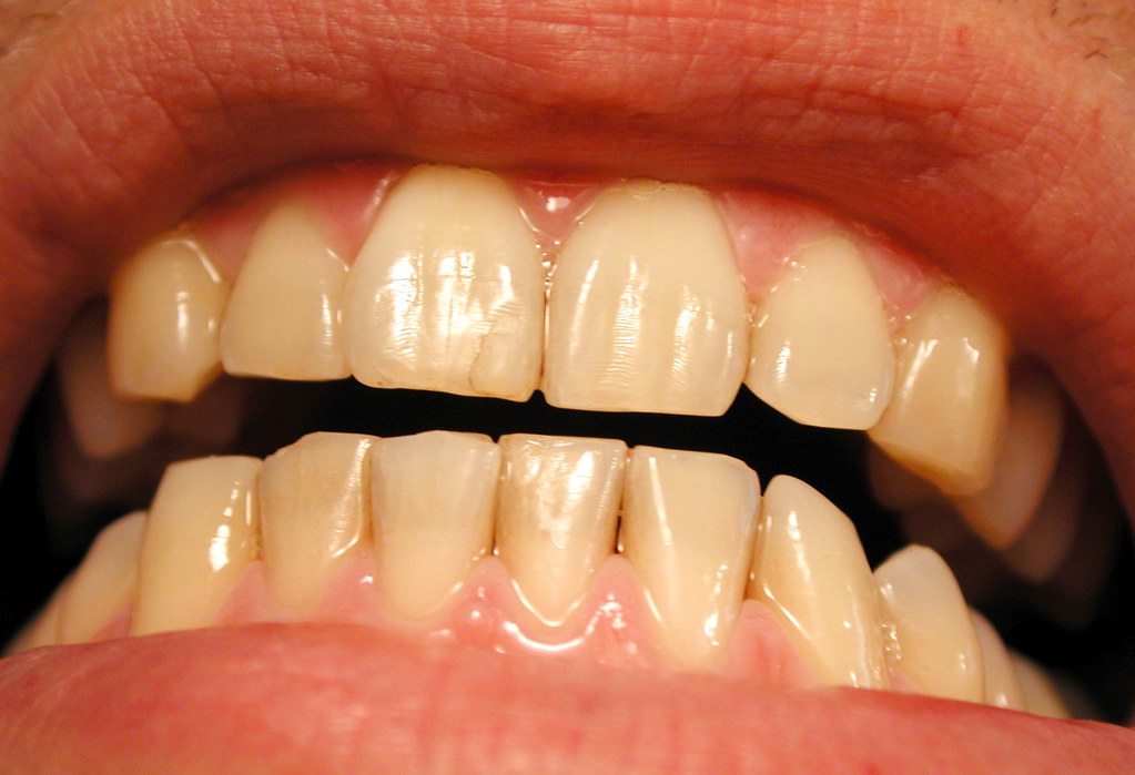 vàng răng