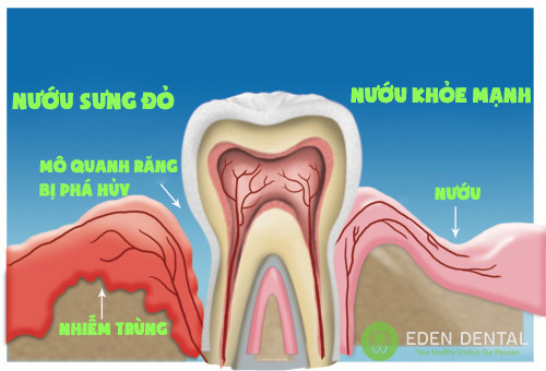 viêm nướu răng 