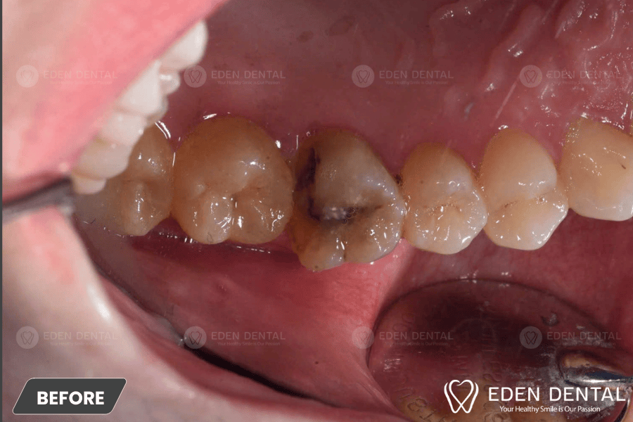 Điều trị răng sâu lớn mặt nhai bằng phục hồi sứ overlay Emax bảo tồn men răng thật